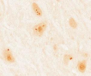 Inmunohistoquímica sobre cerebelo de rata incubada con suero de un paciente con anticuerpos anti-Ma2 por técnica de avidina biotina inmunoperoxidasa. Se observa reactividad en forma de puntos gruesos intracitoplasmáticos en neuronas del núcleo dentado.