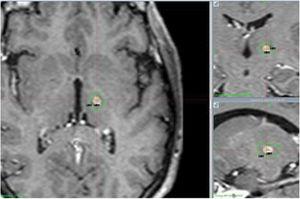 Control con resonancia magnética (RM) cerebral a los 12 meses. RM cerebral en secuencias T1 cortes axial, coronal y sagital. Lesión ovalada milimétrica hipointensa captante de contraste hiperintenso.