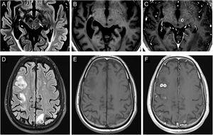 Top row. (A) Axial fluid-attenuation inversion recovery (FLAIR), (B) axial T1 and (C) axial T1 after Gadolinium administration show a focal enhancing lesion in the subthalamic nucleus expanding to the medial and anterior aspect of left mesencephalon. Additionally, a subcortical right insular and a temporal siderotic lesion causing dilation of the lateral ventricle were observed. Bottom row, axial fluid-attenuation inversion recovery (FLAIR) (D), axial susceptibility weighted images (E) and axial T1 sequence after gadolinium administration (F) show several low T2 signal cortically based lesions with peripheral enhancement and surrounding edema which are consistent with neurocysticercosis in a colloidal-vesicular stage.