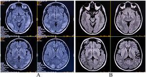 Magnetic resonance imaging of the brain revealing extensive hyperintensities on T2-fluid-attenuated inversion recovery images involving bilateral parietal, occipital, and frontal lobes, suggestive of posterior reversible encephalopathy syndrome (Fig. 1A) and resolution of those altered intensity lesions after two months following the initial presentation (Fig. 1B).