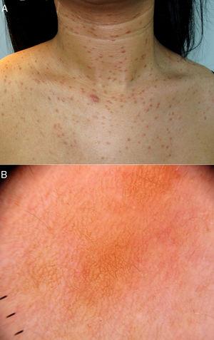 Siringomas eruptivos (caso 1). A) Múltiples pápulas marronáceas en el cuello y escote. B) Dermatoscopia: retículo pigmentado marrón claro y zonas eritematosas sin estructura.