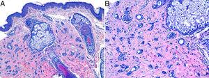 Histopatología (caso 2). A) Epidermis respetada. Múltiples túbulos y cordones epiteliales en dermis reticular, algunos de ellos con prolongaciones en forma de coma (H&E ×100). B) Detalle de los túbulos y cordones epiteliales (H&E ×200).