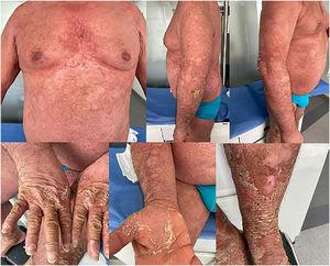 Paciente 2. Psoriasis pustulosa generalizada eritrodérmica, con el 90% de la superficie corporal afectada.