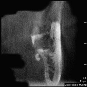 Imagen de TVD: plano coronal después de la osteotomía del diente 38. Luxación de un fragmento radicular por debajo de la línea milohioidea.