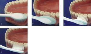 Técnica de Stillman modificada. a) El cepillo dental se coloca en paralelo y se presiona contra la encía. b) A continuación, el cepillo se presiona ligeramente contra los dientes.. c) Y se realizan ligeros movimientos vibratorios. d) Para finalizar, se realiza un movimiento de barrido hacia la corona dentaria.