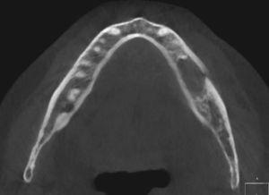Tomografía volumétrica dental: reconstrucción multiplanar axial (MPR).