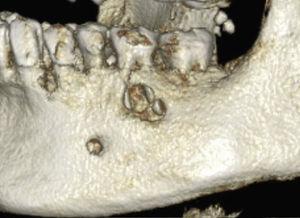 Tomografía volumétrica dental: SSD (reconstrucción de sombreado de superficie).