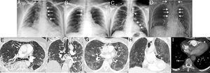 A) Radiografía de tórax posteroanterior en mujer de 60 años ingresada con neumonía bilateral por SARS-CoV-2 en la que se observa un neumomediastino incidental (flechas blancas). Obsérvese la extensión del gas a los tejidos blandos del cuello (flecha negra). B) Radiografía de tórax posteroanterior en varón de 62 años ingresado con neumonía bilateral por SARS-CoV-2, que presentó dolor torácico y disnea. En la radiografía se observa un neumomediastino paratraqueal derecho (flechas). C) Radiografía de tórax posteroanterior en varón de 58 años con neumonía bilateral por SARS-CoV-2, que presentó un episodio de dolor torácico e hipotensión. En la radiografía se observa un neumomediastino con neumopericardio (flecha) y gas en los tejidos blandos de la región supraclavicular derecha (asteriscos). D) Topograma (correspondiente a una TC de tórax) del único neumomediastino diagnosticado mediante TC en una mujer de 64 años con neumonía bilateral por SARS-CoV-2, que presentó dolor torácico y disnea. En el topograma se observa un extenso neumomediastino con extensión a las partes blandas del cuello (flechas). E) Imagen axial de TC de tórax (ventana de pulmón) de la paciente de la imagen D que confirma la presencia de gas ectópico rodeando los bronquios principales (flechas negras) y disecando el pericardio (flechas blancas). F) Imagen coronal de TC de tórax (ventana de pulmón) de la paciente de la imagen D) en la que se puede apreciar aire disecando ambos bronquios principales (flechas cortas) y el tejido graso paratraqueal derecho (flechas largas). G) Imagen axial de TC de tórax (ventana de pulmón) del paciente de la imagen B que confirma la presencia de gas disecando el pericardio (flechas). H) Imagen coronal de TC de tórax (ventana de pulmón) del paciente de la imagen B que muestra el gas disecando el pericardio (flechas). I) Imagen axial de TC de tórax (ventana de mediastino) del paciente de la imagen B en la que se identifica un defecto de repleción en una arteria subsegmentaria del lóbulo inferior derecho (flecha larga). Obsérvese la presencia de gas en la grasa pericárdica (flecha corta).
