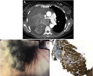 A: Chest computed tomography showed right upper lobe mass with 9cm×12cm, with invasion of RULB and the right pulmonary artery. B: Bronchoscopic examination revealed black pigmented endobronchial lesion, leading to partial occlusion of the RULB. C: Immunohistochemical analysis showed Melan-A and HMB45 expression in tumor cells.