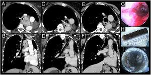 Thoracic CT scan shows an extraluminal mass (*) in previously left pneumoectomized patient causing significant mass effect in the trachea and endoluminal involvement, after mechanical debulking and placement of a Dumon® silicone stent (arrows), axial (A) and coronal (B) views. After systemic treatment, progressive shrinkage of the mass was observed and adequate airway patency was achieved (as seen in C and D) permitting the stent removal. The re-establishment of airway patency after stent removal is showed in CT scan axial (E) and coronal (F) views as well as in bronchoscopy (G). The Dumon® silicone stent removed after several years is showed in H and I.