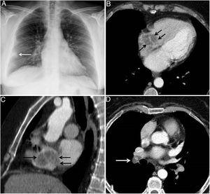 A) Radiografía posteroanterior de tórax en la que se visualiza una condensación en la periferia del pulmón derecho, correspondiente a un infarto pulmonar (flecha). B) y C) Imágenes axial (B) y sagital (C) de TC de tórax en las que se visualiza una masa en la aurícula derecha (flechas). D) Imagen axial de TC de tórax en la que se detecta un defecto de repleción en la arteria intermediaria (flecha).