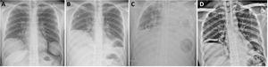 Radiografía de tórax al diagnóstico en la que se evidencian 2 lesiones quísticas no complicadas (A), tras rotura del quiste hidatídico de pulmón izquierdo (B) en la que se objetiva nivel hidroaéreo tras la colocación de ECMO, en la que se evidencia opacificación de todo el hemitórax izquierdo e imagen aérea basal izquierda (C) y una vez suspendido el soporte ventilatorio y de la ECMO (D).