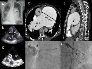 A: Rx tórax, proyección posteroanterior. B: ecocardiografía transtorácica, plano apical 4 cámaras. C: ecocardiografía transtorácica, planoparaesternal eje corto a nivel de los grandes vasos. D-E: tomografía axial computarizada torácica con contraste, ventana mediastino. F-G: coronariografía, proyección anteroposterior. AP: arteria pulmonar; VD: ventrículo derecho; VI: ventrículo izquierdo; AD: aurícula derecha; AI: aurícula izquierda; Ao: aorta; APD: arteria pulmonar derecha.