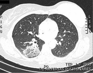 Angio TAC de arterias pulmonares. En el parénquima pulmonar se observó una opacidad redondeada de 37 X 57 mm localizada en el segmento basal posterior de LID con zona central en vidrio deslustrado y reborde de consolidación descrita como signo de «halo inverso».