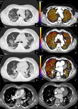 Paciente con alta sospecha de COVID-19, con D-dímero de 80.000, disnea y fiebre de 15 días de evolución. Imágenes axiales de la angiografía pulmonar con TC y mapa de yodo en ventana de pulmón (A, C, E) desde cayado hasta lóbulos inferiores y la correlación con el mapa de yodo (B, D, F) e imágenes axiales (G y H) en ventana de mediastino. Parénquima con extensa afectación en «crazy paving» subpleural y peribroncovascular de predominio en segmentos posteriores, con TEP agudo en arteria lobar inferior derecha y segmentarias inferiores derechas (flechas blancas) y leve hipoperfusión periférica en LID (áreas parcheadas azules) en relación con el tromboembolismo.