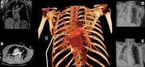 Tomografía computarizada de tórax en plano coronal (A), axial (B) y reconstrucción 3D (C) en la que se puede observar un drenaje torácico malposicionado con perforación de la arteria pulmonar derecha, circulando a través de la arteria principal y con extremo distal (flecha) en la arteria pulmonar izquierda. D: radiografía de tórax postoperatoria. E: radiografía de tórax al alta hospitalaria.