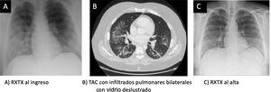 A. Radiografía de tórax al ingreso. B.TAC con infiltrados pulmonares bilaterales con vidrio deslustrado. C. Radiografía de tórax al alta.