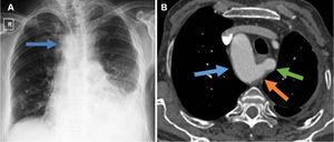 (A) Chest X-ray shows the right sided aortic knob (blue arrow) and left sided increased opacity due to thickened pleura and pleural effusion. (B) CTA shows the right aortic arch (blue arrow), Kommerell diverticulum (orange arrow) and aberrant left subclavian artery (green arrow).