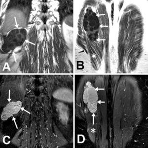 Coronal T1-weighted (A, B) and STIR-weighted (C, D) MRI. Multilocular cystic mass (arrows) involving the ipsilateral longissimus dorsi muscle (asterisk).