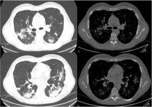 The images on the left show lung window slices from the computerized tomography performed at admission, revealing multiple patchy consolidations associated with COVID-19 pneumonia. On the right, bone window slices with lung calcifications that coincide with the previous opacities. The variability between the slices is due to the fact that the tomography scan at admission obtained 2.5mm slices and the follow-up CT scan obtained 1mm slices.