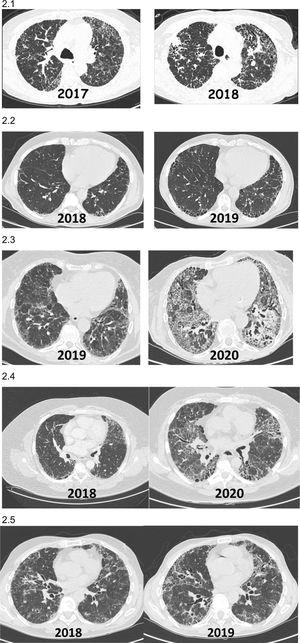 Ejemplos radiológicos (TCAR tórax) de pacientes con EPID fibrótica no-FPI que presentan FPP durante el evolutivo clínico. 2.1) Paciente con neumonitis por hipersensibilidad diagnosticada en el 2017 que mostró al año una importante progresión de sus lesiones tomográficas y reducción funcional pulmonar. 2.2) Paciente con artritis reumatoidea asociado a EPID fibrótica (NIU) diagnosticada en el 2018 con progresión de la fibrosis en las tomografías al año, con incremento de síntomas respiratorios a pesar de encontrarse en remisión articular con metotrexate+abatacept. 2.3) Paciente con síndrome de Sjögren asociado a EPID fibrótica diagnosticada en el 2019 con progresión de las lesiones en la tomografía y disminución de función respiratoria al año a pesar de micofenolato mofetil+prednisona. 2.4) Paciente con fibrosis pulmonar secundaria a EPID no clasificable que presenta progresión de la fibrosis a los 24 meses del diagnóstico 2.5) Paciente con neumonitis por hipersensibilidad crónica fibrosante que empeora clínica y radiológicamente a pesar de evitar exposición, tratamiento corticoideo y micofenolato, tras 12 meses del diagnóstico.