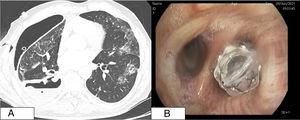 (A) Chest CT scan with cavitary lesion and pneumothorax associated with pleural drainage inside the pleural cavity (note thickening of the visceral pleura). (B) Endoscopic view of the Zephyr valve at the entrance to the right lower lobe.