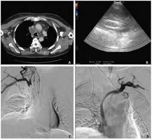 (A) Chest CT (axial slice, mediastinal window): right paratracheal lymph node cluster with extrinsic compression of the superior vena cava. (B) Endobronchial ultrasound, Doppler-mode analysis showing lymph node cluster with elongated hyperechoic image (stent), containing no evidence of blood flow. (C) Superior vena cavogram showing no passage of contrast agent through the stent, consistent with stent thrombosis. (D) Superior vena cavogram showing complete recanalization after new stent placement.
