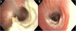 Flexible bronchoscopy showed necrosis of the anterior wall associated with two cartilage rings denudation and right edge detached from the wall of the mid-trachea (A). After 3 weeks, flexible bronchoscopy showed reduction of necrosis area and re-epithelization of cartilage ring (B).