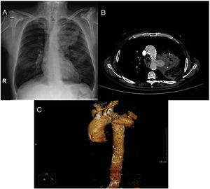Chest X-ray image showing alveolar infiltrate in the LUL (A). Chest CT angiogram imaging showing ruptured pseudoaneurysm with alveolar hemorrhage in LUL (B). Reconstructed 3-dimensional image showing thoracic aorta with ruptured pseudoaneurysm (C).