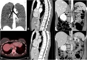 (A) Coronal minimum intensity projection (minIP) thoracic CT image (lung window) shows multiple small cystic lesions in both lungs. (B) Sagittal thoracic CT image (mediastinal window) shows a low-attenuation prevertebral mass (arrow). (C) Coronal abdominal CT image shows low-attenuation lesions in the retroperitoneum (arrows). (D) Axial fused lower thoracic PET/CT image shows minimal FDG uptake by the posterior mediastinal lesion. (E) and (F) Sagittal thoracic (E) and coronal abdominal (F) CT images show an almost complete resolution of the masses (arrows) 3 months after sirolimus therapy was started.