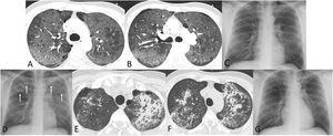 (A) and (B) Axial thoracic CT images (lung window) show extensive ground-glass opacities in both lungs, consistent with Pneumocystis jirovecii pneumonia. (C) Posteroanterior chest radiograph performed on the day of discharge shows resolution of opacities after treatment with cotrimoxazol and prednisolone. (D) Three days after being discharged, a repeat chest radiograph shows new-onset bilateral consolidations (arrows). (E) and (F) Axial thoracic CT images (lung window) show large peribronchial consolidations with bronchial lumen dilatation, a pattern typical of organizing pneumonia. (G) Posteroanterior chest radiograph performed one month after (D) shows an almost complete resolution of the pulmonary opacities.