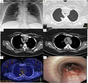 (A) Chest X-ray. (B) In the Thorax CT, an irregularly bounded mass lesion in the upper lobe posterior segment in the right lung and irregularities in the trachea. (C, D) In the Thorax CT Mediastynal conglomerate lymphadenopathies. (E) Focally increased 18F-FDG uptake is observed in the nodular lesion in the right upper lobe and at the carina level. (F) Invasive lesion to the posterior wall at the middle level of the trachea in bronchoscopy.