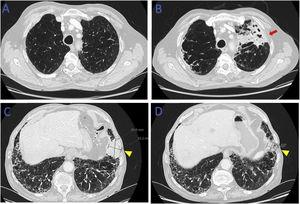 (B) Computed tomography of the chest (lung window) showing opacification on the left superior lung lobe (red arrow) not previously present (A). Computed tomography of the chest (lung window) showing lung carcinoma in the left inferior lobe (yellow arrowhead) before (C) and at the time (D) of reported symptoms.