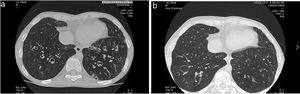 (a) Chest CT at presentation of a 13-year-old boy with a congenital heart disease depicting widespread left and right lower lobes varicose and cystic bronchiectasis. He had a chronic productive cough at presentation. (b) Chest CT of the same boy 3 years later depicting resolution of right lower lobe and many subsegments of the left lower lobe after intensive treatment including intravenous antibiotics at first diagnsosis. The adolescent was completely cough free.