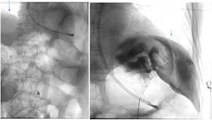 Fluoroscopy images performed during the radiological percutaneous gastrostomy (PRG) procedure. In the image on the left, the left diaphragmatic dome is not visible due to the very cranial location, which was maintained after air insufflation (the vertical arrow shows the right diaphragm and the letter A shows the procedure syringe), The second image shows the descent of the stomach after ventilation of the patient with an end-expiratory pressure of 14cmH2O (see arrow).