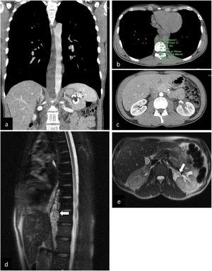 (a–c) (original images) – Whole-body CT – (a) coronal, contrast-enhanced (b) axial, unenhanced: prevertebral heterogeneous low-density (4 HU – fluid content) mass involving the thoracic aorta, from D6 to L1 (through diaphragm); (c) axial, contrast-enhanced: discrete heterogeneous density of retroperitoneal fat and central low attenuation areas in the left kidney; (d–e) (original mages) Chest-abdomen MRI – (d) MRI (sagittal): multiseptated serpiginous lesion in the posterior mediastinum/prevertebral (white arrow), forming a structure that molds to vascular structures (10.5cm in the craniocaudal diameter). (e) MRI (axial): left perirenal lesion molding to the renal hilum (white arrow), hyperintense on T2-weighted sequences, with multiloculated areas (equally hyperintense on T2).