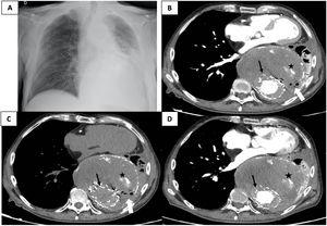 (A) Posteroanterior chest X-ray findings: mediastinal widening due to thoracic aortic aneurysm (TAA) with tracheal deviation to the right and a large retrocardiac opacity with significant volume loss of the left pulmonary base. (B) Contrast-enhanced thoracic computed tomography angiography (CTA) showed a TAA with aortic stent-graft (black-thin-arrow), a large aneurysmal sac (163mm×140mm (TxPA)) with a mural thrombus in it, an atherosclerotic plaque and irregular high attenuation areas within the aneurysmal sac suggesting calcium deposits (black star) similar to previous studies with no evidence of endoleaks and a left lung consolidation with atelectasis. Presence of air bubbles within the thrombosed aneurysm with a suspicious aortobronchopulmonary fistula lesion (white arrow). (C) Non-contrast CTA was useful to distinguish between endoleaks and calcifications within the aneurysmal sac. The high attenuation areas (black star) remained the same with the non-contrast and contrast-enhanced CTA suggesting calcifications. (D) 3 months earlier contrast-enhanced CTA to show the stability of the volume of the TAA, aneurysmal sac, calcifications and left lung atelectasis. No evidence of endoleaks or aortobronchopulmonary fistula.