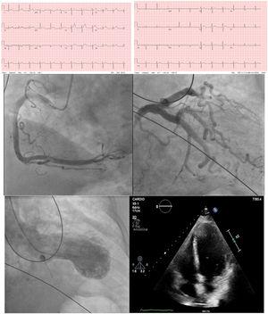 (a) ECG on the left performed with chest pain shows diffuse ST-segment elevation in I, II, avL and V1–V6, rectification in III and avF. ECG on the right performed after 2 months shows normalized leads. (b) Coronary angiogram on the left reveals the arteries without coronary disease. Left: right coronary artery. Right: left coronary artery. (c) Left ventriculography in systolic frame shows apical segment akinesis with a mild depressed LVEF (46%). (d) Echocardiography performed 2 months later shows a preserved contractibility with normalization of the LVEF (60%).