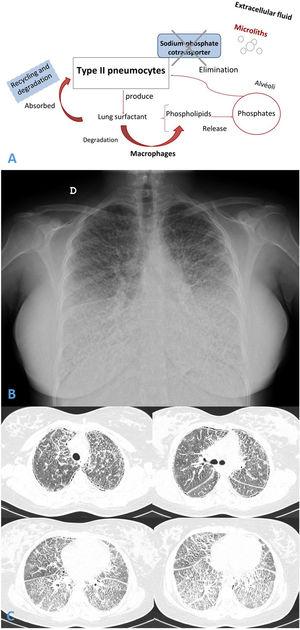 (A and B) Chest radiograph presented diffuse, fine bilateral reticulation with typical image of micronodular appearance (“sandstorm lung”). (C) Thorax high resolution computed tomography (HRCT) revealed widespread bilateral lung micro-calcifications, ground-glass opacities, interlobular septal thickening and subpleural cysts.