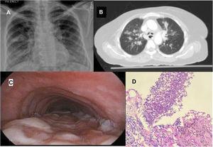 (A) Chest X-ray showing bilateral alveolar opacities, more prominent in the right upper lobe. (B) CT Chest showing nodular ground glass opacities in the right upper lobe. (C) Bronchoscopic view from the mid trachea showing multiple white plaques on the posterior tracheal wall, extending up to the carina (seen distally in the picture). (D) Lung parenchyma with alveolar spaces infiltrated by septated hyphae branching at acute angles.