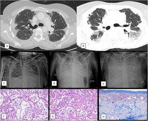 (A) Non-contrast thoracic CT scan that shows pleural thickening and irregular apical opacities as well as traction bronchiectasis suggestive of pleuroparenchymal fibroelastosis (diagnostic CT, two years before referral to a transplant center). (B) Contrast-enhanced thoracic CT scan that reveals progression of the images consistent with pleuroparenchymal fibroelastosis in the upper lobes as well as ground glass opacities and consolidation on the lower lobes, suggestive of diffuse alveolar damage (CT performed during acute exacerbation). (C) Chest X-ray, antero-posterior (AP) projection. First day of ECMO weaning attempt. Patient had been weaned from mechanical ventilation several weeks before. X-ray reveals mild bilateral pulmonary opacities and consolidation of the upper pulmonary lobes consistent with PPFE. Femoral and jugular ECMO cannulas and tracheostomy tube are also identified. (D) Chest X-ray, antero-posterior (AP) projection. Third day of ECMO weaning attempt. Patient had been weaned from mechanical ventilation several weeks before. Thoracic X-ray shows an increase in pulmonary opacities with consolidation in the lower pulmonary lobes and the PPFE pattern. (E) Fifth day after ECMO weaning attempt (weaning attempts ceased on day three). Thoracic X-ray shows a diffuse pattern of severe bilateral consolidation (white lung pattern). (F) Autopsy sample of lung (H/E staining, 20× magnification) reveals presence of hyaline membranes and neutrophilic inflammation in the alveoli with disrupted epithelium, compatible with diffuse alveolar damage in exudative (acute) stage. (G) Autopsy sample of lung (H/E staining, 20× magnification) shows thickening of the alveolar septa, in addition to proliferation of type II pneumocytes and myofibroblasts, compatible with diffuse alveolar damage in proliferative (subacute) stage. (H) Autopsy sample of lung (trichrome staining, 20× magnification) shows marked pleural thickening with fibrosis with abundant collagen deposition.