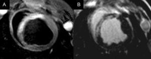 Imagen de resonancia magnética de un corte medioventricular en un infarto agudo de miocardio, donde se muestra el área en riesgo en las secuencias T2-STIR como la zona hiperintensa en el septo anterior (A) y la zona necrótica en las secuencias de realce tardío en la misma localización (B). La diferencia entre la extensión del área en riesgo y la zona necrótica corresponde al miocardio salvado.