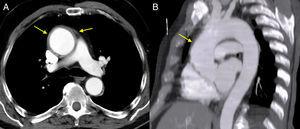 Tomografía computarizada de tórax que muestra aneurisma y engrosamiento parietal de aorta ascendente. A: imagen axial. B: reconstrucción multiplanar en eje sagital.