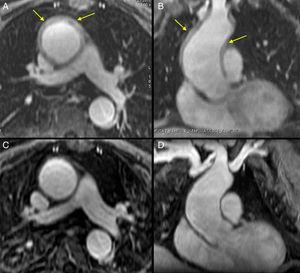 Resonancia magnética en secuencias FAME potenciadas en T1 con contraste. A (imagen axial) y B (imagen coronal): se observa aneurisma de la aorta ascendente, con un diámetro máximo de 47 mm previo a troncos supraaórticos, y engrosamiento de 7 mm de la pared de la aorta ascendente y la descendente. C y D: control de resonancia magnética 7 meses después del tratamiento, con iguales cortes; se aprecia grosor normal de la pared de la aorta y persistencia del aneurisma aórtico.