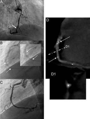 A: lesión ateromatosa grave del segmento medio de la coronaria derecha (flecha). B: implante del stent bioabsorbible; se visualizan las dos marcas radioopacas en ambos extremos del stent (flechas discontinuas). C: resultado angiográfico tras el implante del stent bioabsorbible. D: evaluación angiográfica no invasiva mediante tomografía computarizada a los 2 años, en la que únicamente se observan las dos marcas radioopacas (flechas discontinuas) a nivel del segmento medio de la coronaria derecha. D1: corte transversal al mismo nivel en el cual se confirma la ausencia de stent intraluminal y tejido que indique hiperplasia neointimal.