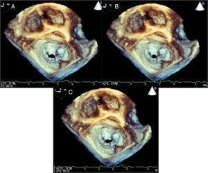Tipos de orificio regurgitante mitral por ecocardiografía transesofágica tridimensional. A: centrolateral. B: central. C: centromedial.