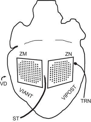 Representación esquemática de la situación de los electrodos en la preparación experimental utilizada. ST: estimulador; TRN: termopar; VD: ventrículo derecho; VIANT: pared anterior del ventrículo izquierdo; VIPOST: pared posterior del ventrículo izquierdo; ZM: zona modificada; ZN: zona no modificada.