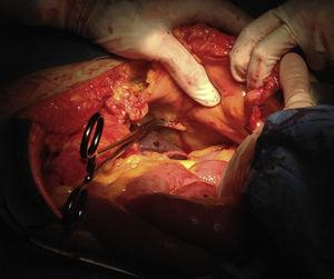 Imagen intraoperatoria del pinzamiento de la arteria diafragmática inferior izquierda.