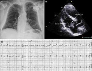 A: radiografía de tórax con el desfibrilador transvenoso implantado. B: imagen de ecocardiograma transtorácico donde se aprecian el cable de desfibrilación y una gran vegetación que afecta a la válvula tricúspide. C: electrocardiograma tras la cirugía cardiaca.