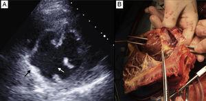 A: ecocardiograma que muestra la comunicación interventricular (flecha blanca) y el seudoaneurisma (flecha negra). B: corazón explantado; el ventrículo derecho está abierto y una pinza introducida a través de la válvula aórtica atraviesa una gran comunicación interventricular en la parte posterior del septo.